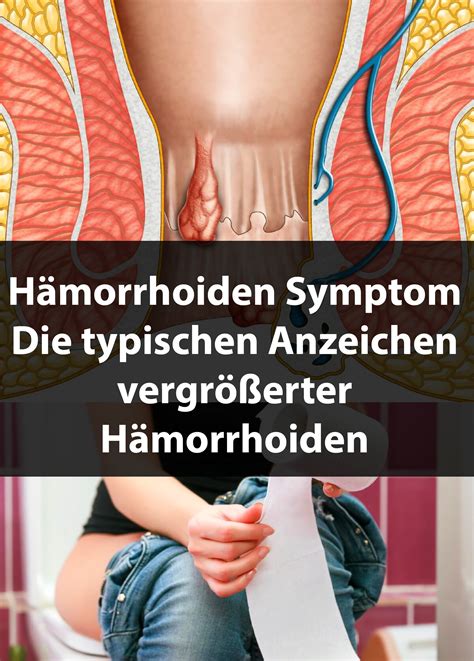 bilder von hämorrhoiden|hämorrhoiden bilder äußere.